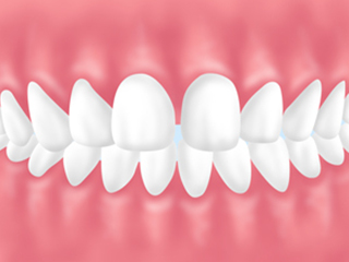 前歯のすきっ歯の矯正